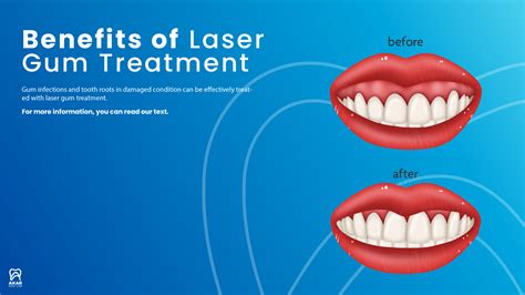 Laser Gum Treatment Akar Dental