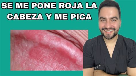 TENGO PICAZÓN EN MI ZONA INTIMA BALANITIS DR DAVID CAMPOS YouTube