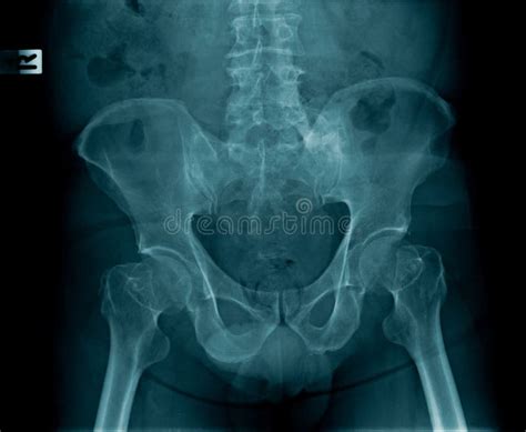 X-ray image of human spine stock image. Image of orthopedic - 148722895