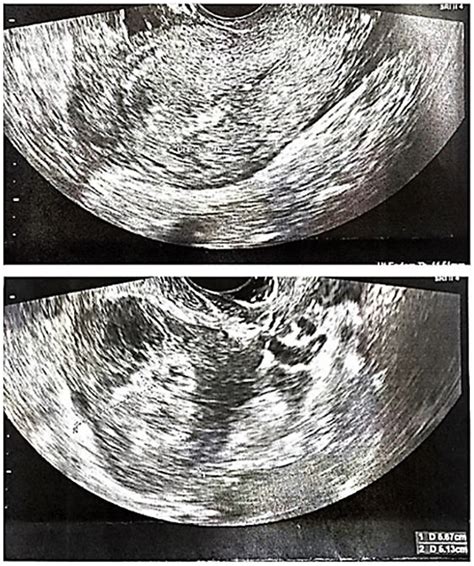 Transvaginal Sonography Showing Ruptured Tubal Stump Ectopic Pregnancy Download Scientific