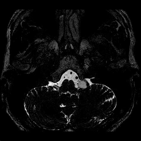 Sudden Sensorineural Hearing Loss Dr Sean Flanagan