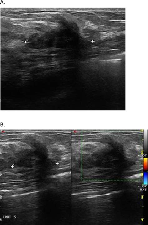 A 3 Months Postoperative Breast Ultrasound Shown A Hypoechoic