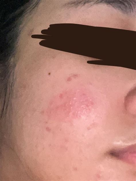 Dry Flaky Somewhat Itchy Patch On My Skin Rtretinoin