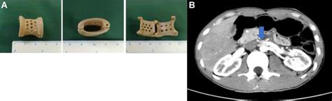 Systematic Review Of Endovascular Versus Laparoscopic Extravascular