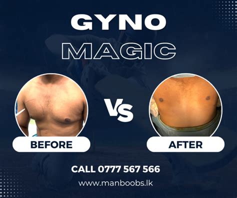 Sri Lanka S Gynecomastia Treatment Centre Call