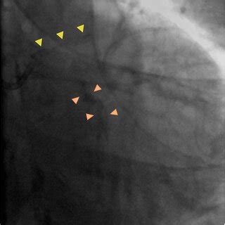 Summary of coronary artery calcification lesion modification tools ...