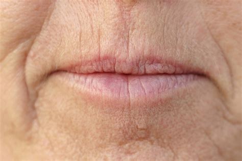 Lip Lines | Winnipeg | Victoria Park Medispa (The Derm Centre)