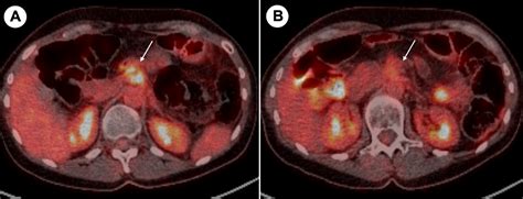 Irreversible Electroporation For Locally Advanced Pancreatic Cancer