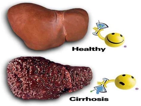 Cirrhosis Of Liver Final Pptx