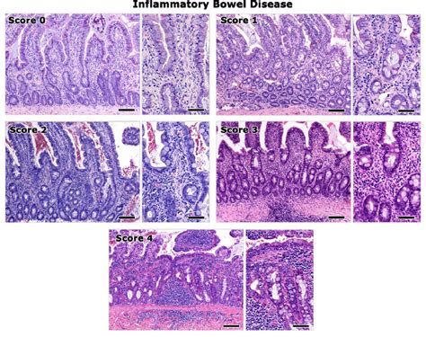 Representative Images Of The Histopathological Grading Of IBD