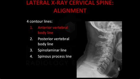 X Ray Soft Tissue Neck Medicalrojak