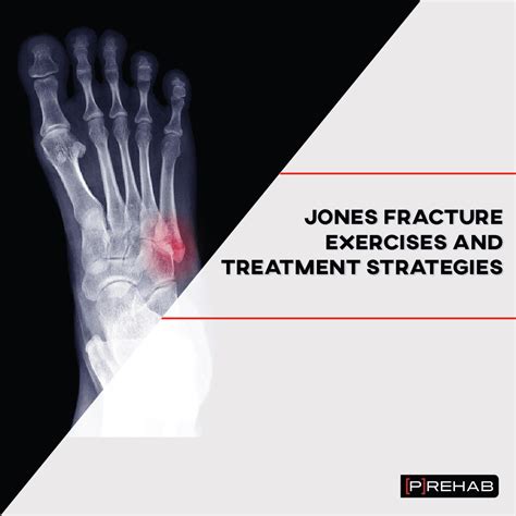 Jones Fracture 5th Metatarsal