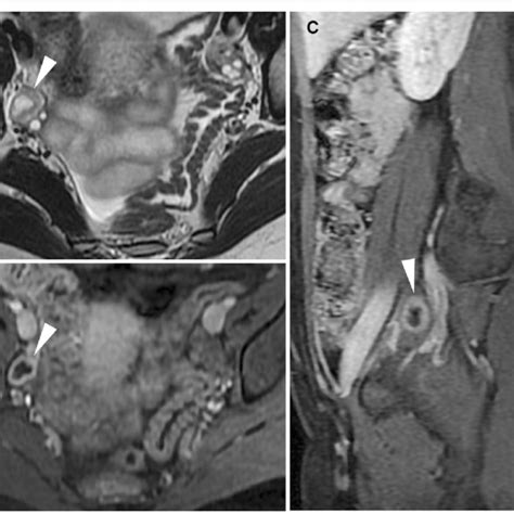 Mri Of Pelvic Congestion Syndrome In A 26 Year Old Woman With Chronic