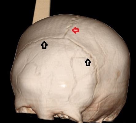 Skull Anatomy Sutures