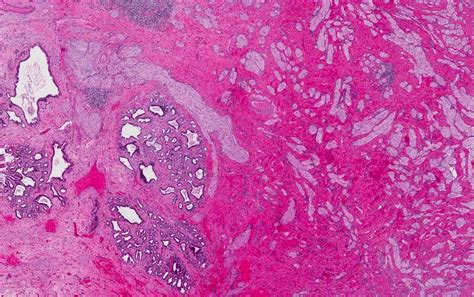 Traumatic Neuroma Pathology Outlines