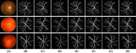 Cmc Free Full Text Dt Net Joint Dual Input Transformer And Cnn For Retinal Vessel Segmentation