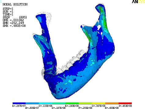 Finite Element Analysis Of The Human Mandible At 3 Different Stages Of