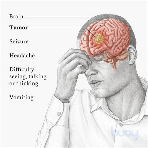 Most Common Brain Tumor 7 Things You Should Know