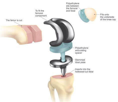 Patients Guide To Total Knee Replacement Atx Orthopedics