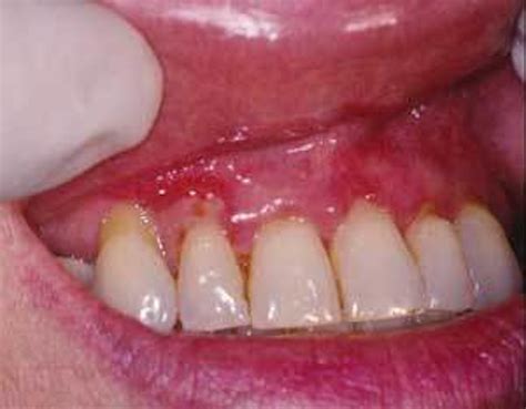 Mucous Membrane Pemphigoid Registered Dental Hygienist Rdh Magazine