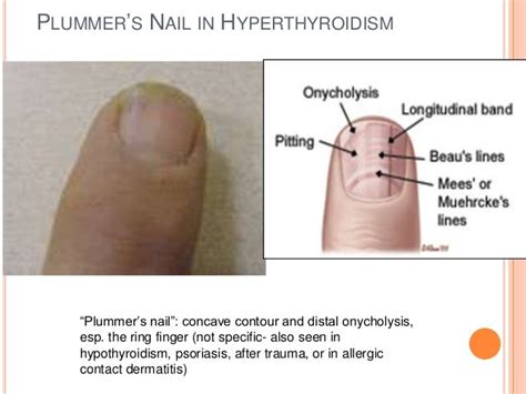 Plummers Nails Hypothyroidism Onycholysis Causes Pictures Photos It Occurs In Patients