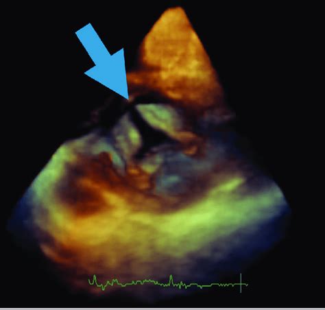 Cleft Mitral Estudiado Con Ecocardiograf A 3D Se Aprecia Con Gran