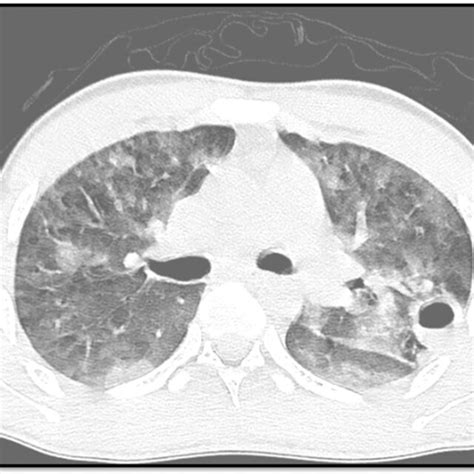 Thoracic Computed Tomography Showing Diffuse Bilateral Pulmonary