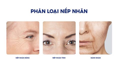 HiỂu VỀ NẾp NhĂn VÀ CÁc GiỮ GÌn LÀn Da TƯƠi TrẺ