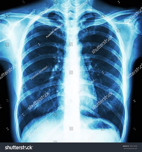 Film Chest Xray Pa Upright Show Stock Photo Edit Now