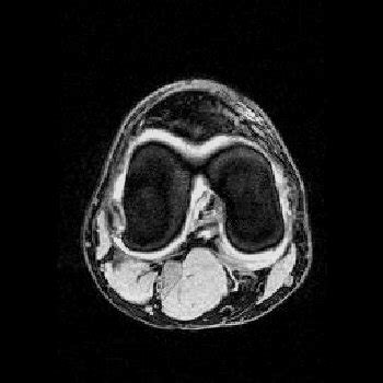 MRI Images - Axial Knee MRI Images T2 Weighted - MR-TIP.com