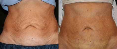 Before And After J Plasma Subdermal Skin Tightening Abdomen Lookyoungernews