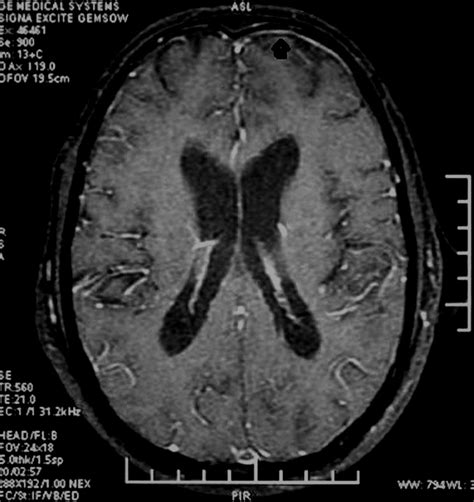 Neurological manifestations of scrub typhus | Journal of Neurology