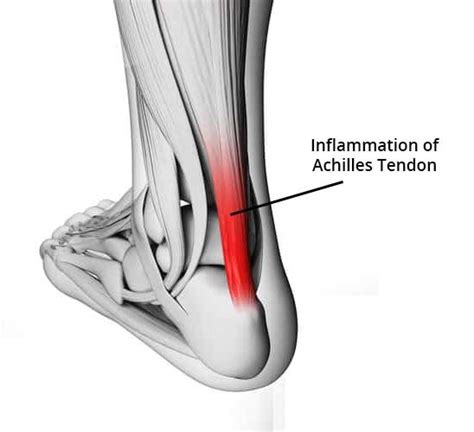 achilles tendon pain   action