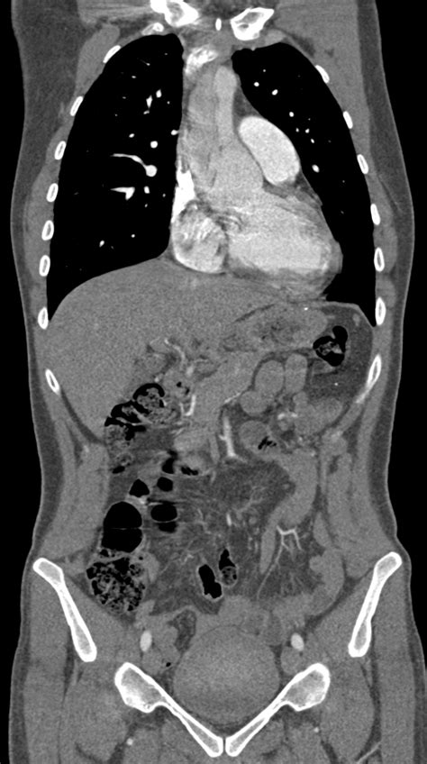 File Marfan Syndrome With Ascending Aortic Aneurysm And Stanford A