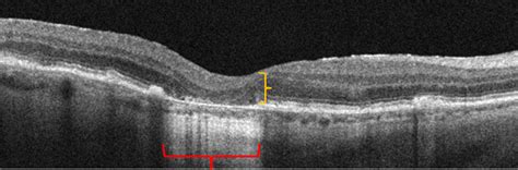 What Macular Degeneration to Geographic Atrophy Progression Really Looks Like