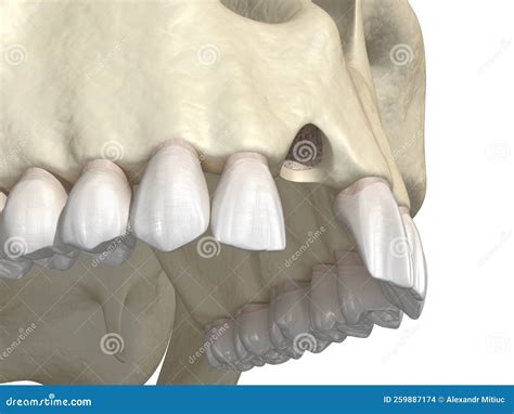 Aesthetic Defect After Losing Central Incisor Tooth Medically Accurate