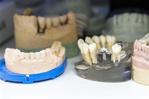 Varios Modelos De Reparto Dental Centrarse En El Modelo Fundido Con