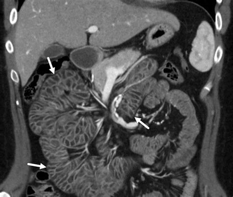 Tyrosine Kinase Inhibitor–related Intestinal Lymphangiectasia | Radiology