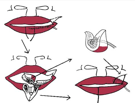 Labial Artery Anatomy