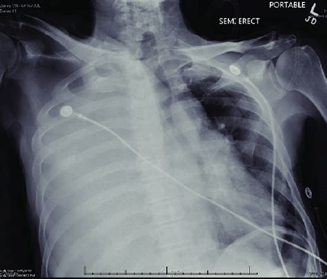 Chest X Ray Showing Complete Right Hemithorax Opacification With