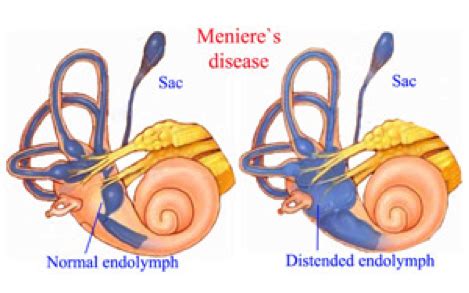 Meniere’s Disease - What is Meniere’s Disease? - Sunnybrook Hospital