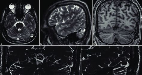 A E Focal Brain Herniation Into Transverse Sinus A Axial T2