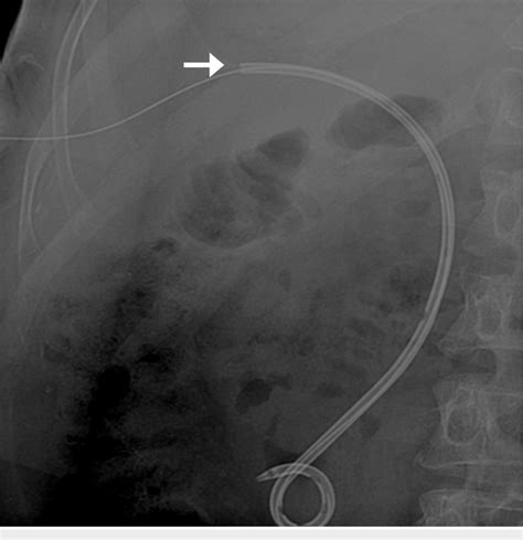 Fluoroscopic Spot Image Showing Glidewire Cannulating The Dislodged