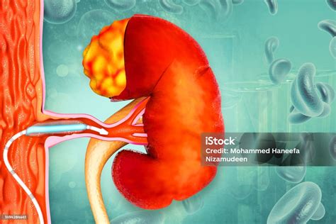 ureteral stent placement  illustration stock photo  image