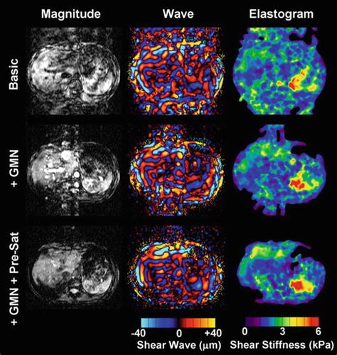 Liver Magnetic Resonance Elastography Technique Radiology Key