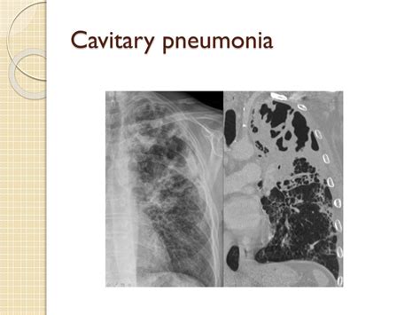 PPT - Community acquired pneumonia PowerPoint Presentation, free ...