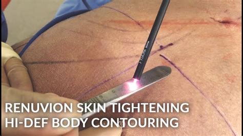 Renuvion J Plasma Skin Tightening Hi Definition Body Contouring With