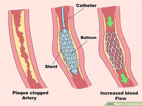 How To Treat Nstemi With Pictures Wikihow Health