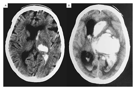 Spontaneous Intracerebral Hemorrhage Nejm