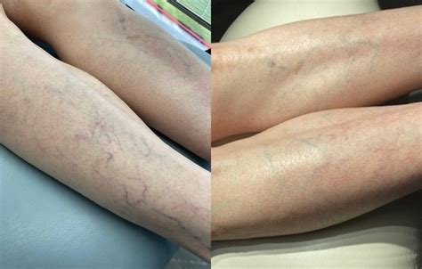 Sclerotherapy Laser Vein Treatment Before After Photos Patient